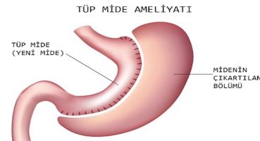 Tüp Mide Ameliyatı Nedir ve Neden Yapılır?