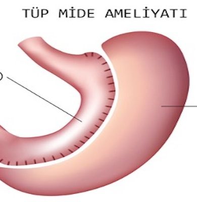 Tüp Mide Ameliyatı Nedir ve Neden Yapılır