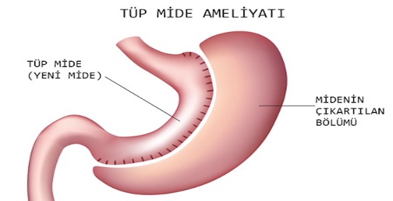 Tüp Mide Ameliyatı Nedir ve Neden Yapılır