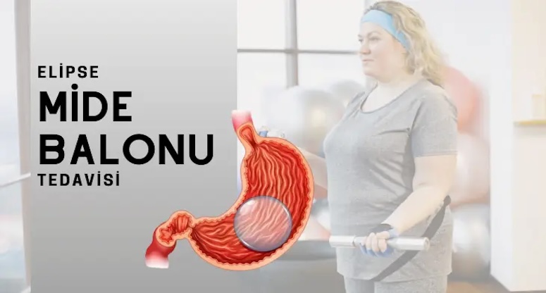 Allurion Mide Balonu
