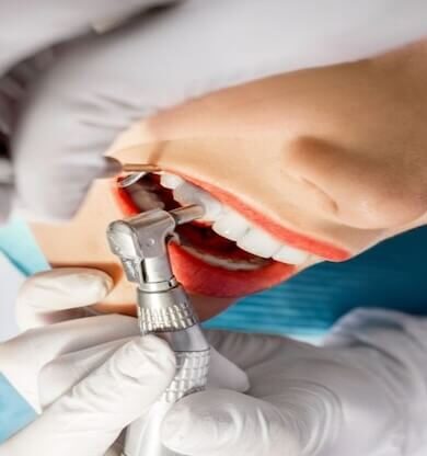 Diş Taşı Temizliği Nedir ve Neden Önemlidir